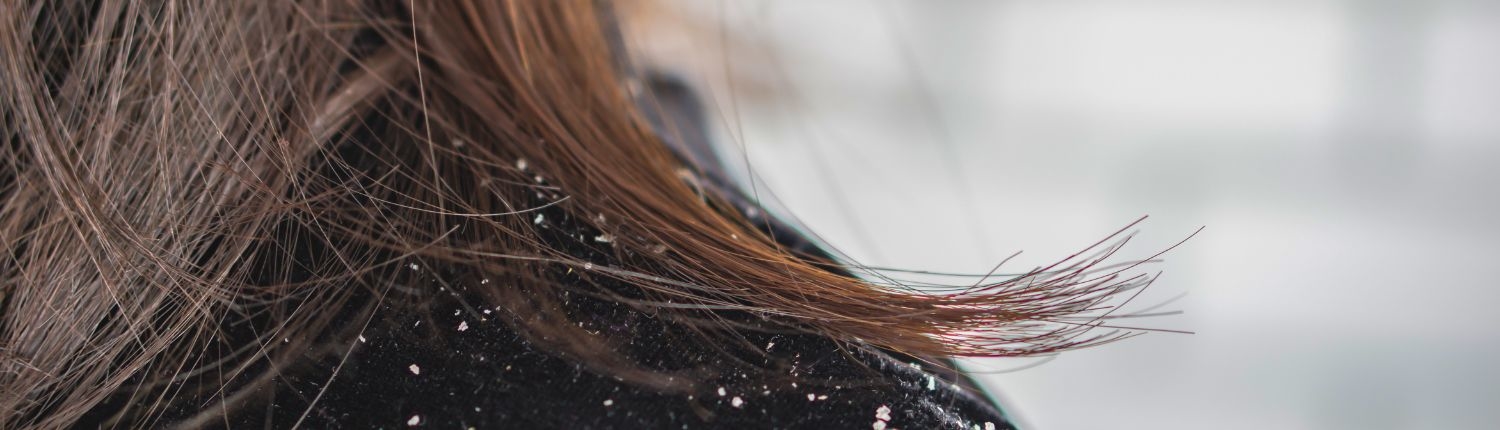 Pellicule et cheveux : d'où viennent-elles et comment les éliminer ? 5